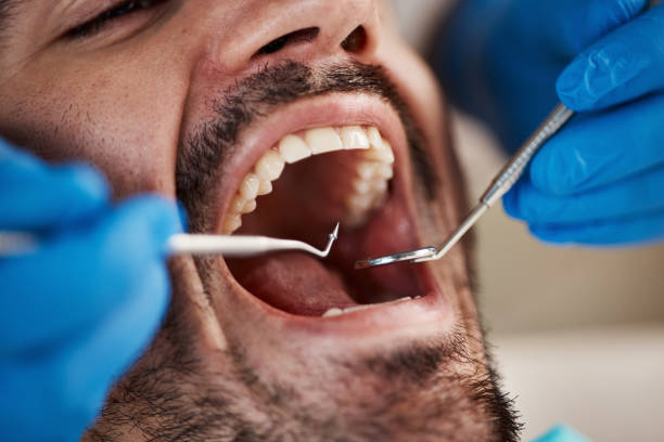 Best Emergency Dentist for Lost Fillings or Crowns in Caruthersville, MO